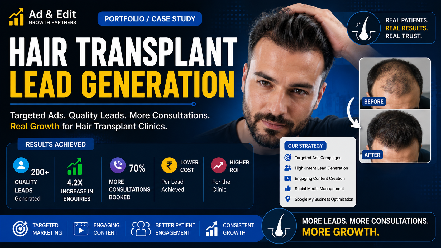 Hair Transplant Lead Generation